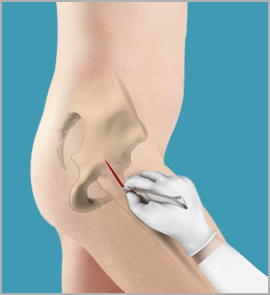 Minimally Invasive Hip Replacement